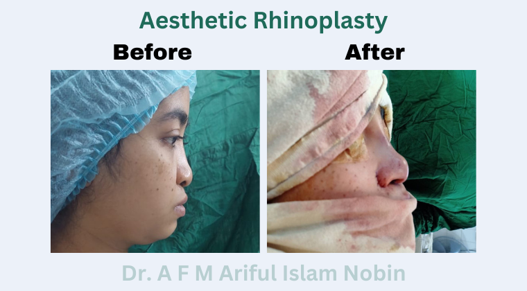 Aesthetic Rhinoplasty