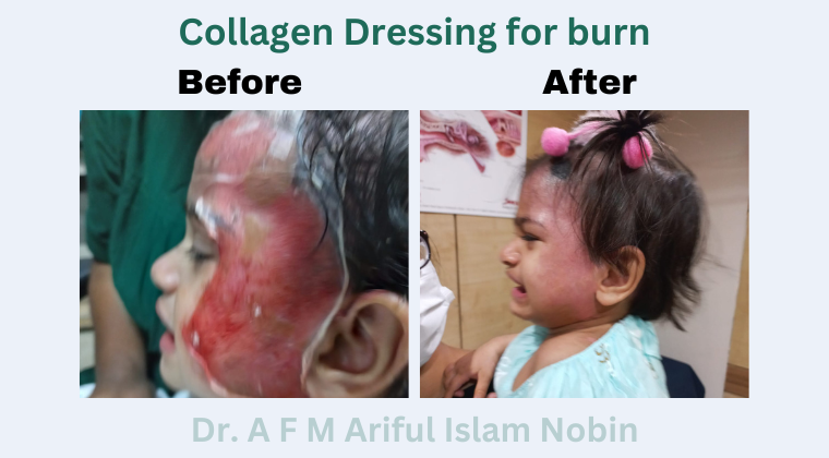 Collagen Dressing for Burn