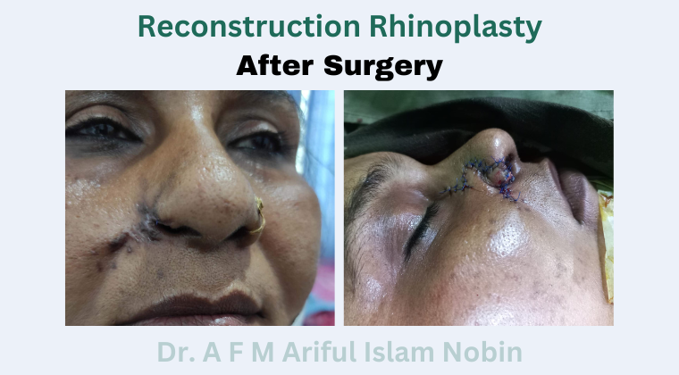 Reconstruction Rhinoplasty
