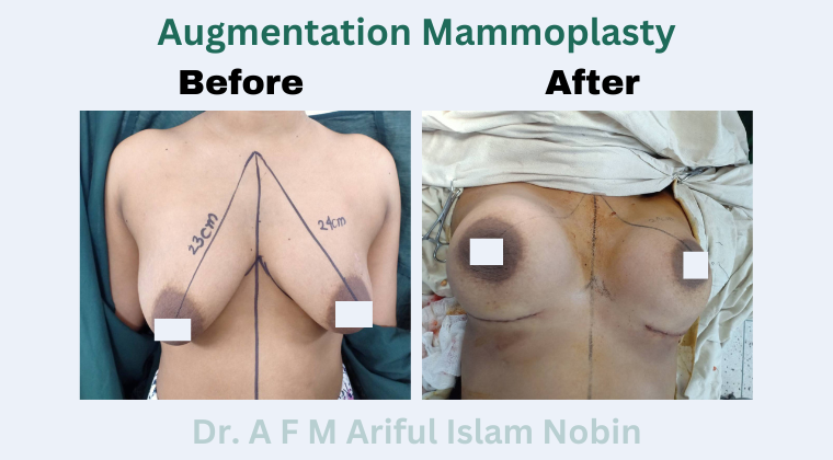 Augmentation Mammoplasty