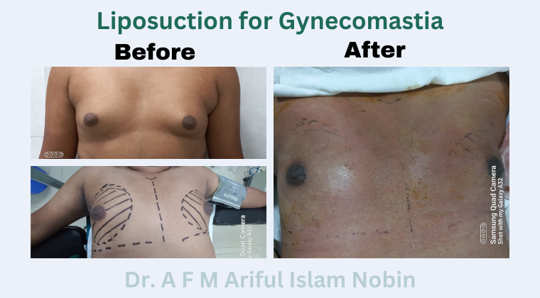 Liposuction for Gynecomastia