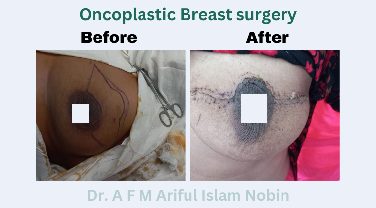 Oncoplastic Breast Surgery