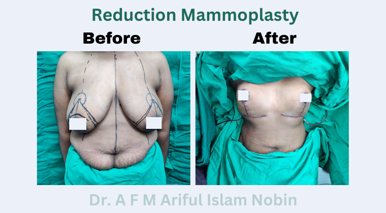 Reduction Mammoplasty