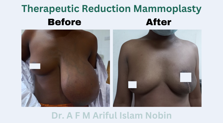 Therapeutic Reduction Mammoplasty