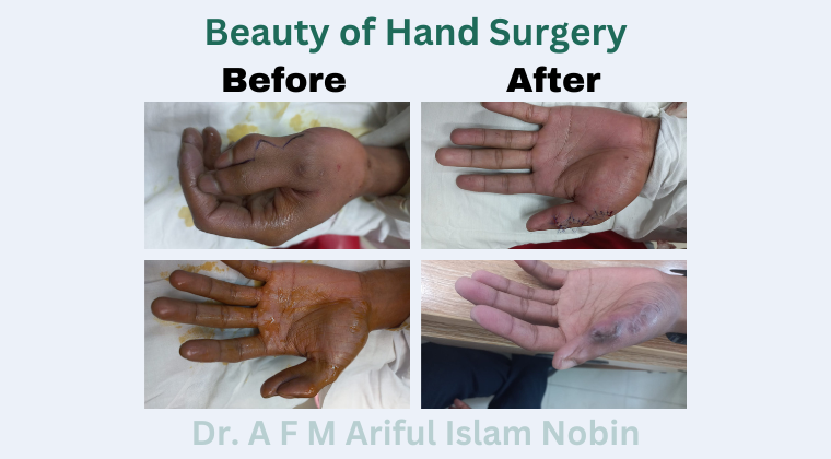 Polydactyly Surgery