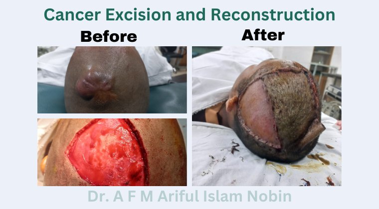 Cancer Excision and Reconstruction