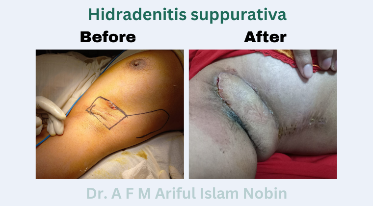 Hidradenitis suppurativa